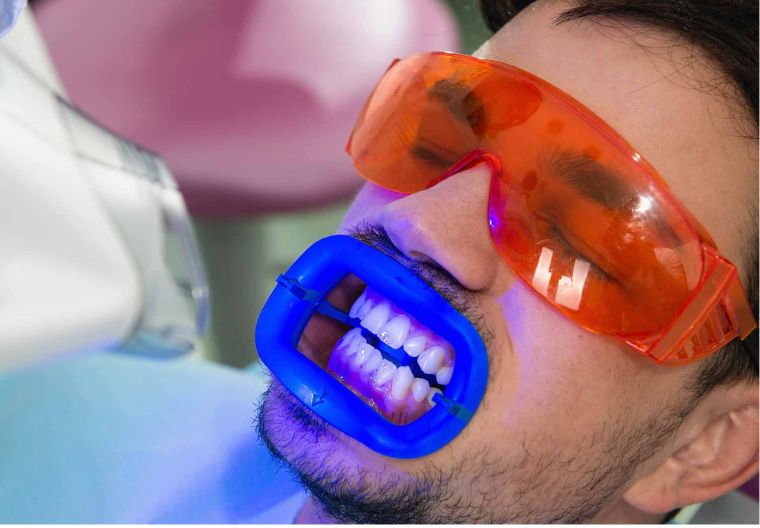 Benefits of Laser Teeth Whitening: Why It May Be Worth the Investment